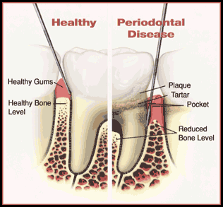 how to get rid of plaque build up between teeth